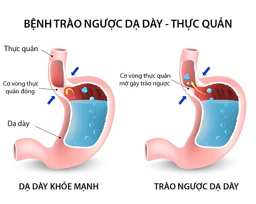 Do bị trào ngược dạ dày